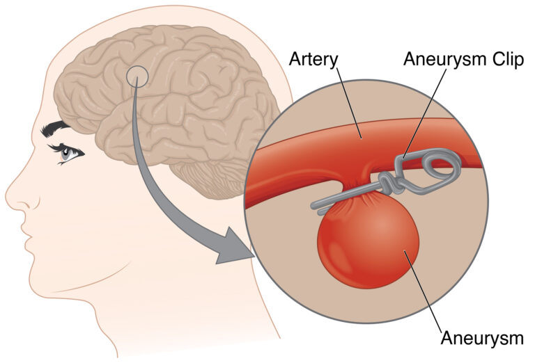 Ilustração mostra onde é colocado um clipe de metal para conter o aneurisma cerebral.