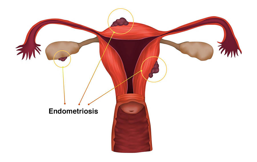 Ilustração indica o que significa endometriose.