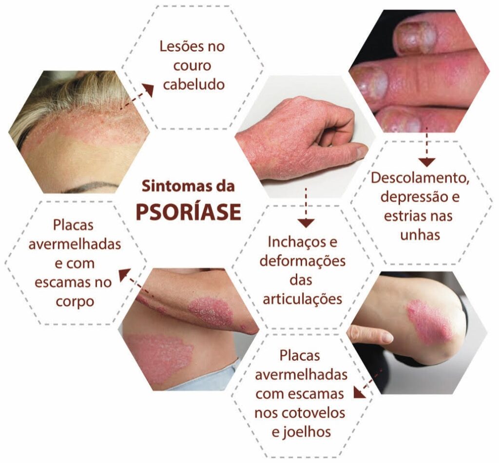 Sintomas da psoríase. Fonte: Sociedade Brasileira de Dermatologia